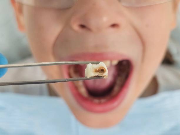 Best Emergency Tooth Extraction in Germantown, IL